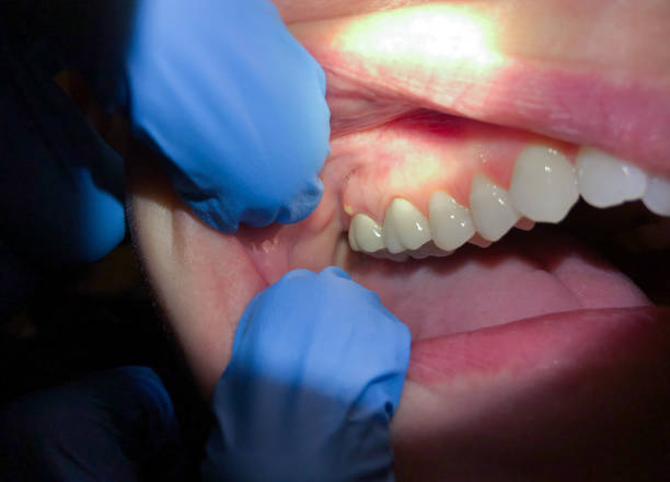 Best Emergency Wisdom Teeth Removal in West Middlesex, PA