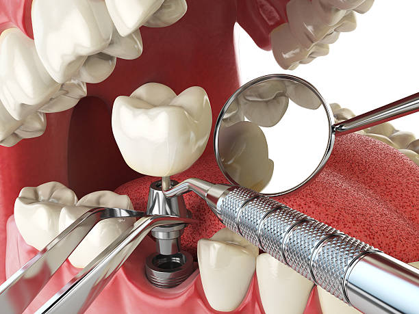 Best Emergency Dental Care for Broken or Chipped Teeth in West Middlesex, PA
